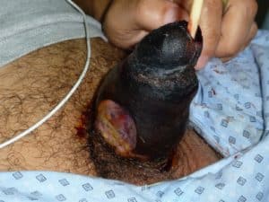 Complications after surgery on the penis