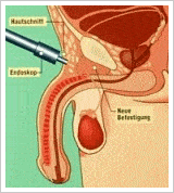 Tecnica operatoria per l’allungamento del pene
