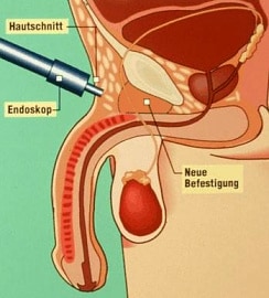 Penis enlargement surgery after